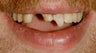 Trauma, Implants, Full Restoration