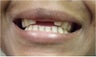 Mini Dental Implants replacing missing front teeth