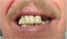 Mini Dental Implants replacing missing teeth