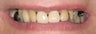 Full mouth reconstruction