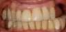 Dental implants, bone grafts, all porcelain crowns