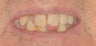 Dental implants, all porcelain restorations