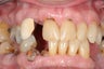 Dental implants, all porcelain crowns
