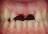 Dental Implants For Missing Front Teeth