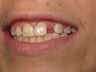 Dental Implant for Missing Lateral Incisor
