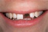 Dental Implant For Missing Front Tooth