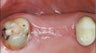 Dental Implants For Missing Back Teeth
