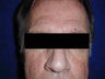 Rhinophyma