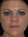 Microdermabrasion and Obagi Skin Care Products