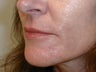 Dermabrasion