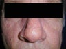 Rhinophyma