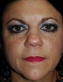 Microdermabrasion and Obagi Skin Care Products