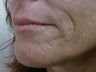 Dermabrasion