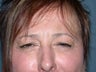 Dysport injections