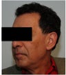 Dysport treatment for Crow's Feet