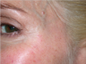 Improvement of crow's feet wrinkles with Dysport