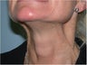 Dysport treatment of neck Bands