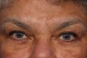 Radiesse and Dysport to Glabella
