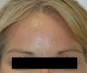Dysport Injections Orange County Before and After