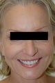 Dysport Injections Before and After Photos