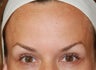Dysport in the horizontal forehead lines.