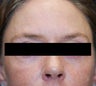 Dysport in the horizontal forehead lines.