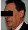 Dysport treatment for Crow's Feet
