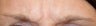 Dysport injections