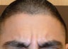 Dysport injections