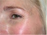 Improvement of crow's feet wrinkles with Dysport