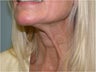 Dysport treatment of neck Bands