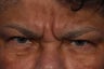 Radiesse and Dysport to Glabella