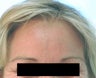 Dysport Injections Orange County Before and After