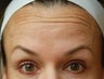 Dysport in the horizontal forehead lines.
