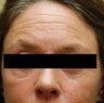 Dysport in the horizontal forehead lines.