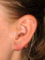 Earlobe Repair