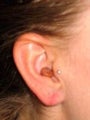 Earlobe Repair