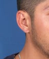 Gauge Earring Repair Otoplasty Surgery