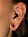 Earlobe Repair