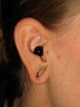 Earlobe Repair