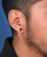 Gauge Earring Repair Otoplasty Surgery