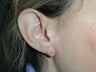 Ear reconstruction for missing earlobe