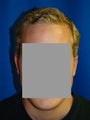 Otoplasty (Ear Surgery)