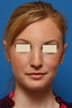 Otoplasty for prominent ears ("Ear Pinning")