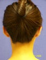 Otoplasty (Ear Surgery)