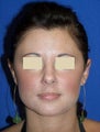 Otoplasty (Ear Surgery)