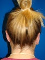 Ear Surgery (Otoplasty)