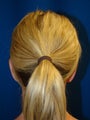 Ear Surgery (Otoplasty)