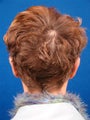 Ear Surgery (Otoplasty)