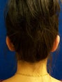 Ear Surgery (otoplasty)